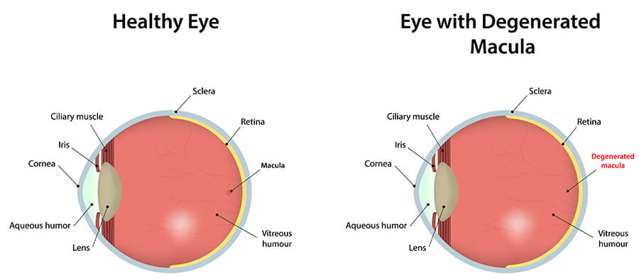 Age Related Macular Degeneration Eye Chart